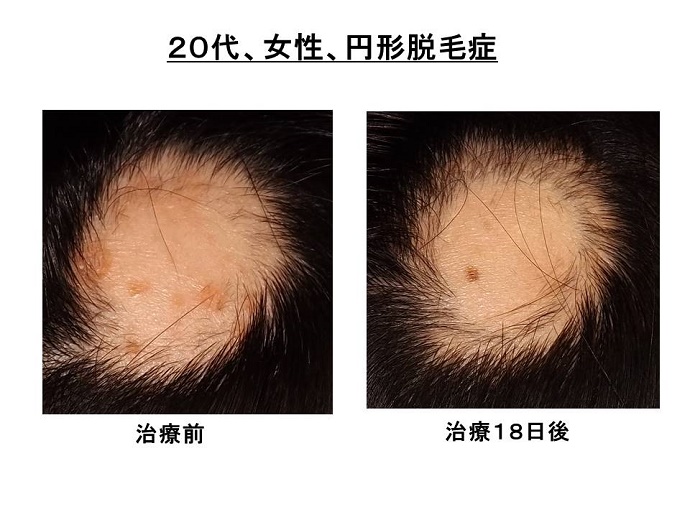 円形脱毛症　病院""